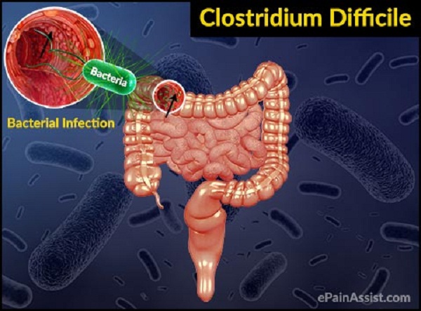 clostridium-difficile